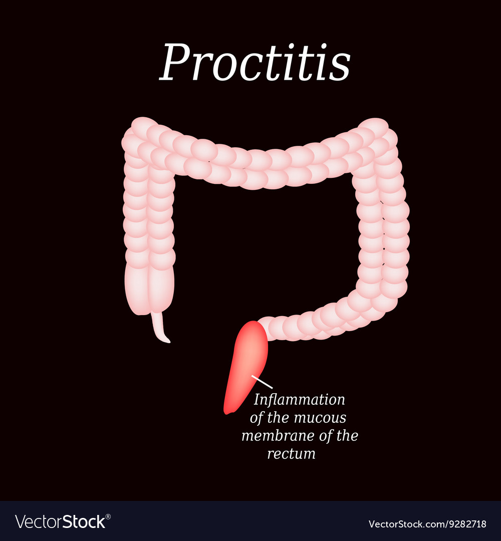 Colon Proctitis On A Black Royalty Free Vector Image