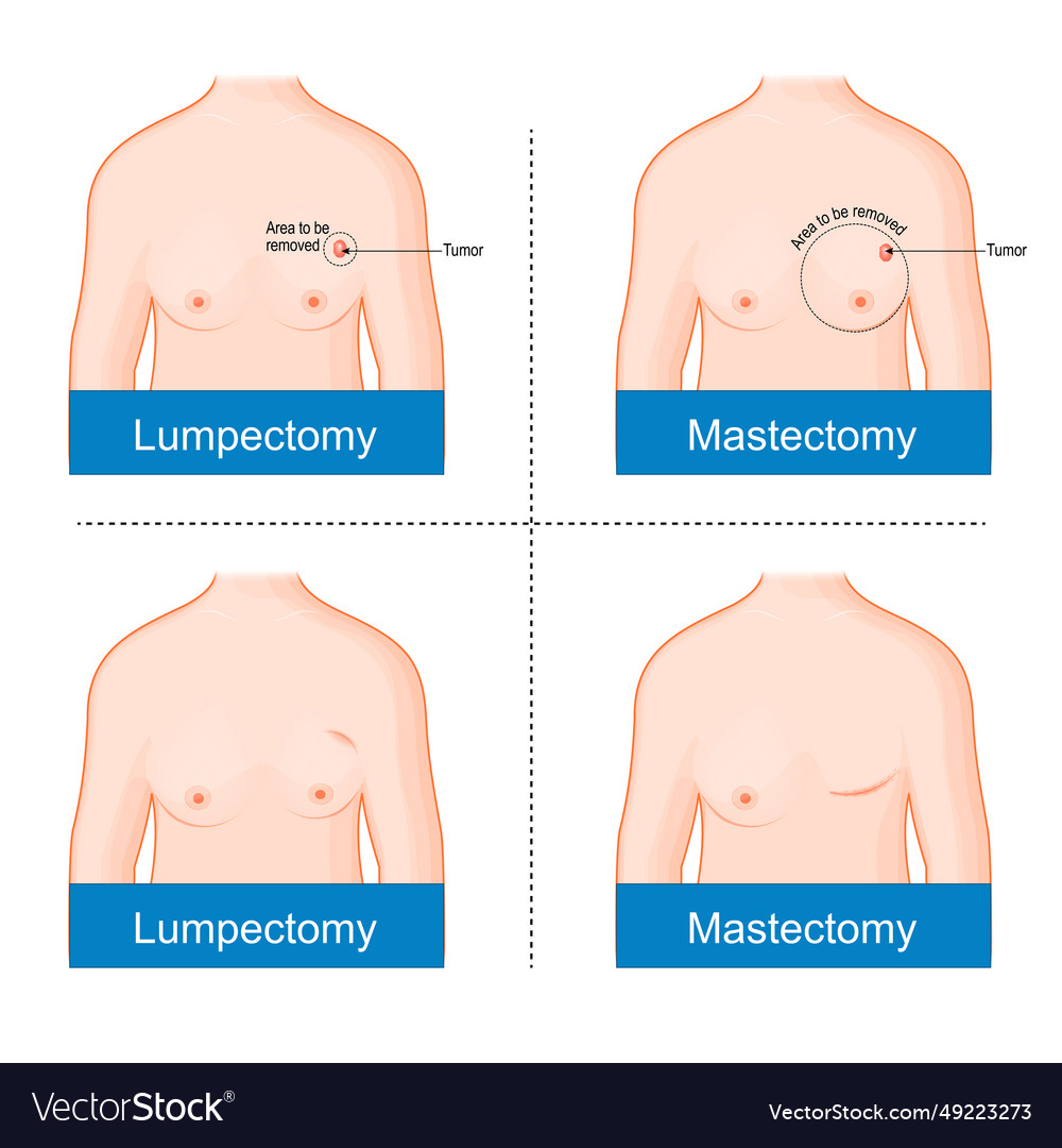 Mastectomy And Lumpectomy Royalty Free Vector Image