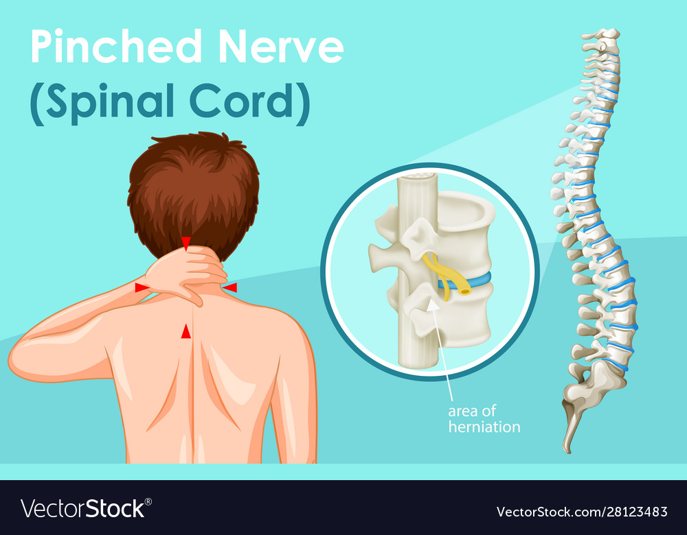 Pinched nerve numb anus