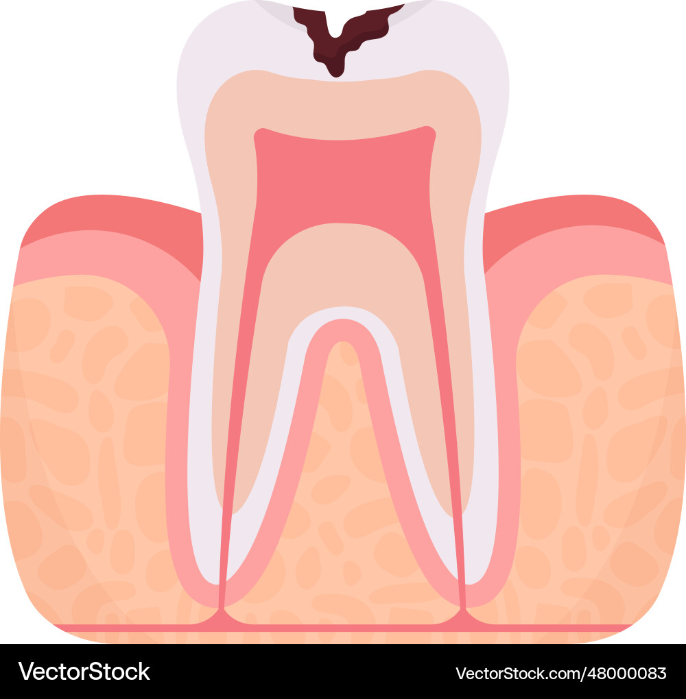 Deep caries tooth problem Royalty Free Vector Image