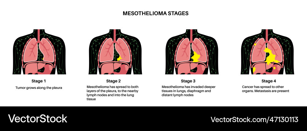 Captivating 4 Stages Of Mesothelioma Picture Digital Art Captivating 4 Stages Of Mesothelioma Picture Digital Art