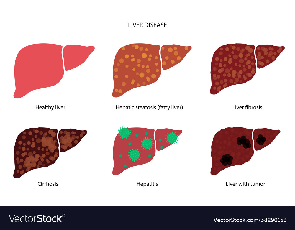 Liver disease concept Royalty Free Vector Image