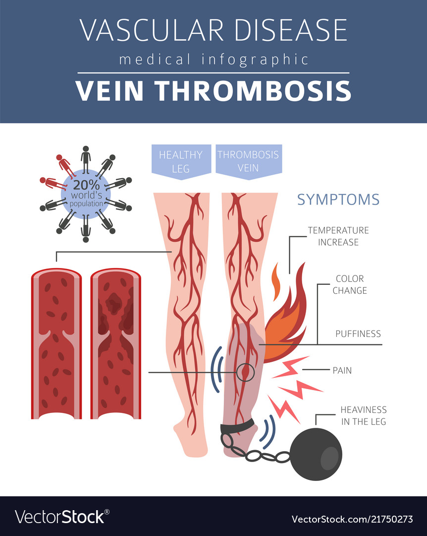 Vascular diseases vein thrombosis symptoms Vector Image