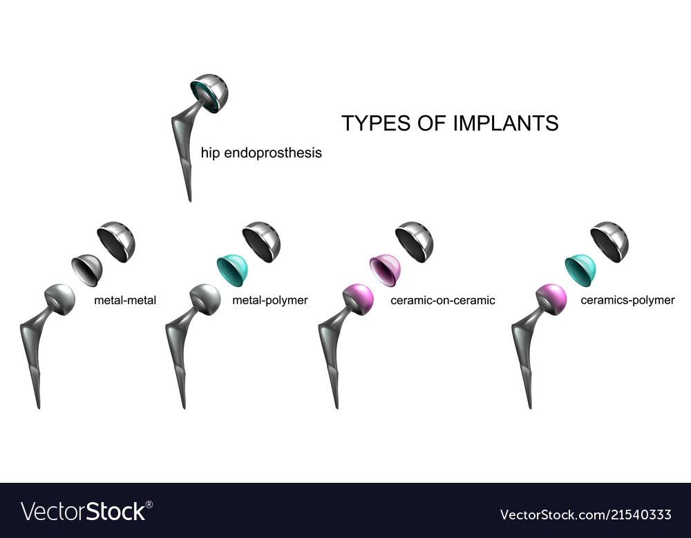 Types of endoprostheses by type of material Vector Image