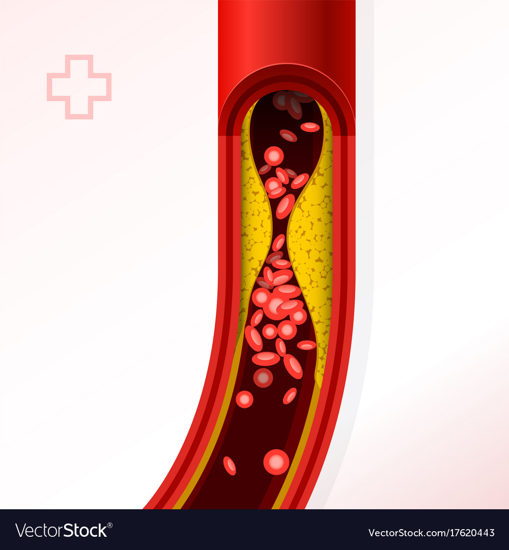 Artery section with cholesterol buildup Royalty Free Vector