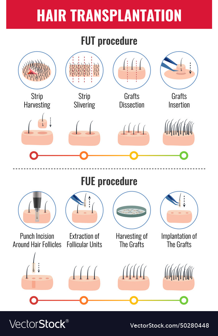 Hair Transplantation Infographics Royalty Free Vector Image