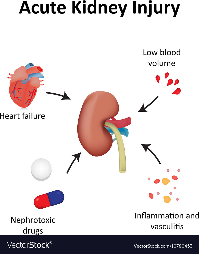 Acute Kidney Injury Pathophysiology Diagram Kidney Injury Acute ...