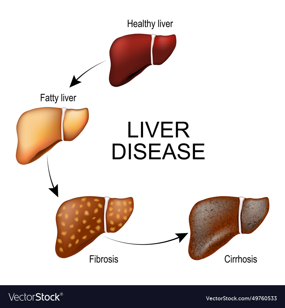 Stages of liver damage Royalty Free Vector Image