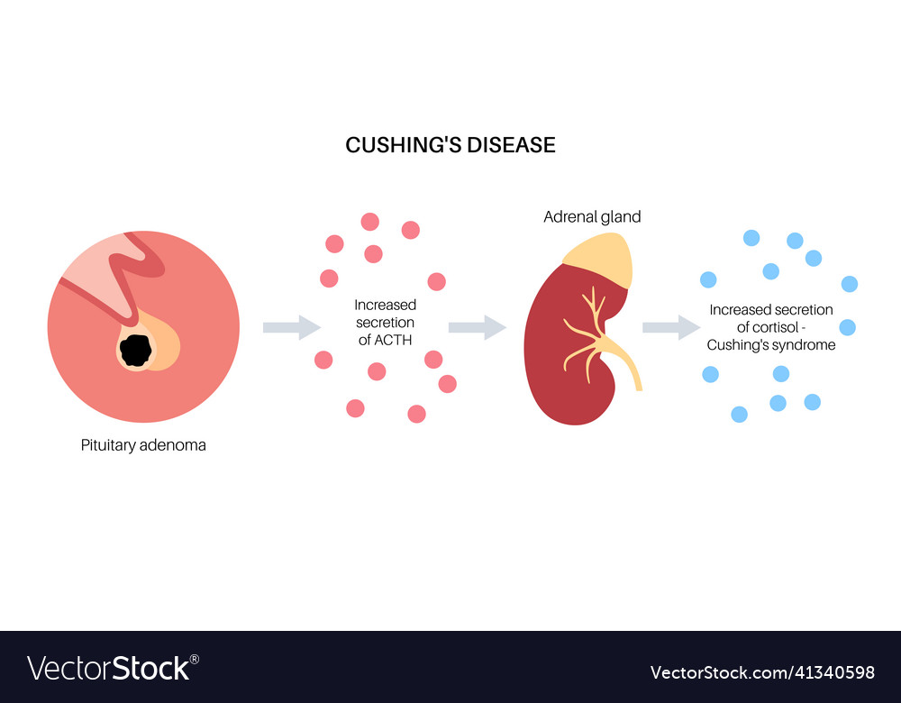 Cushing desease poster Royalty Free Vector Image