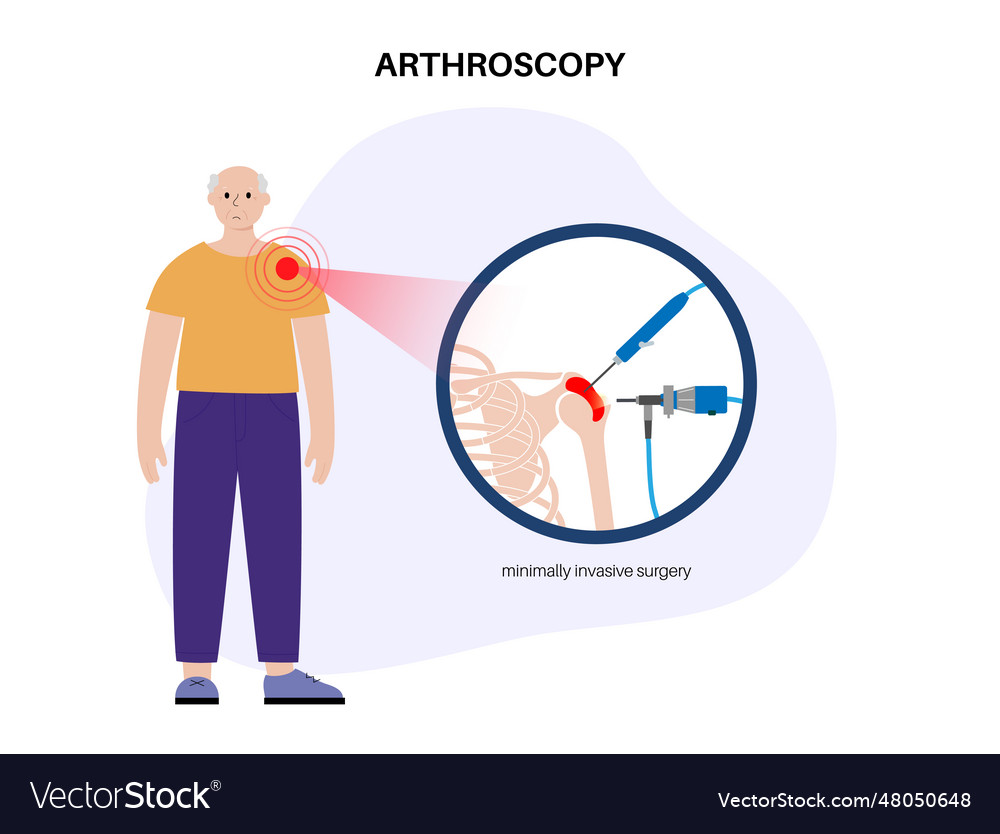 Shoulder Arthroscopy Poster Royalty Free Vector Image