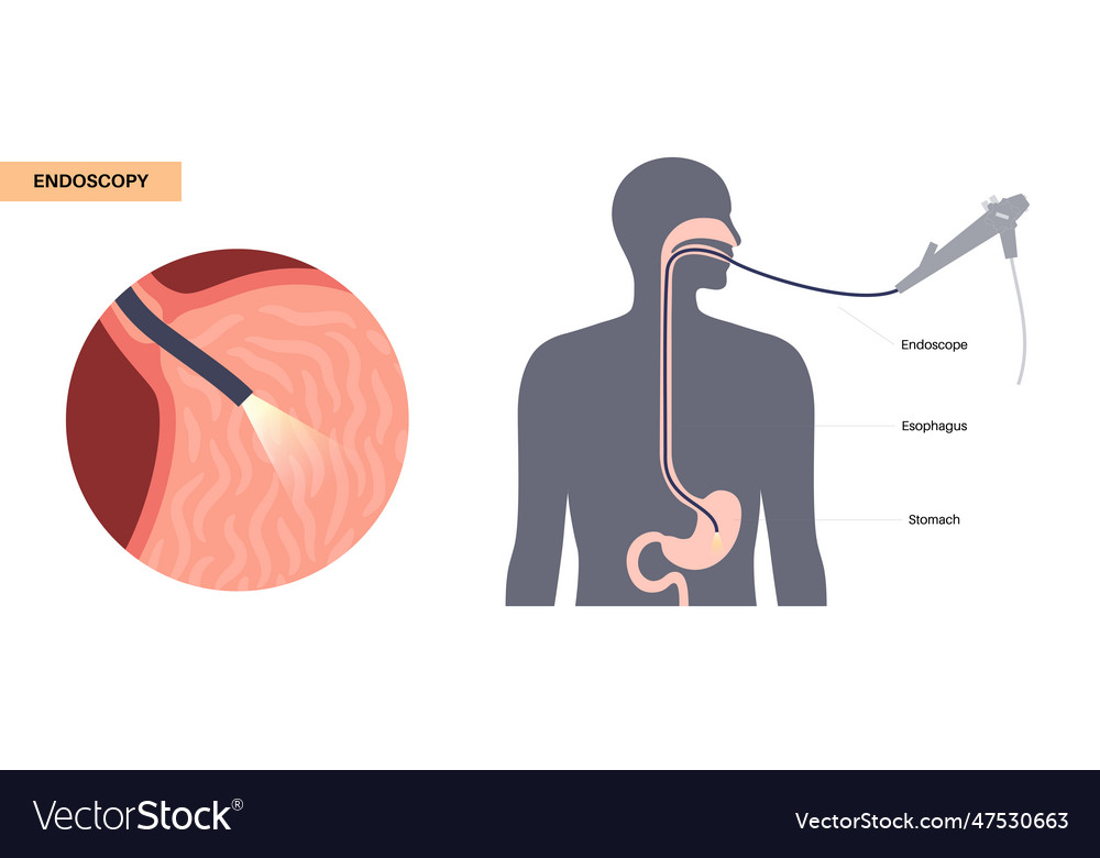 Gastroscopy endoscopy procedure Royalty Free Vector Image