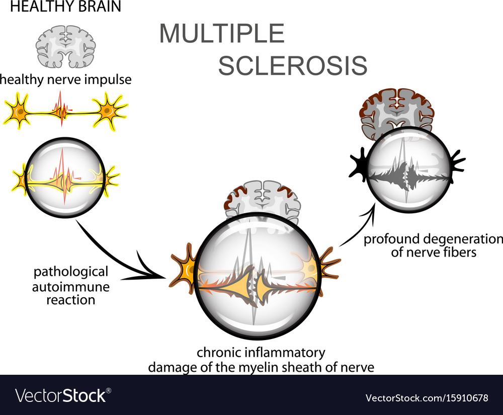 Multiple Sclerosis Neurology Royalty Free Vector Image Multiple Sclerosis Neurology Royalty Free Vector Image