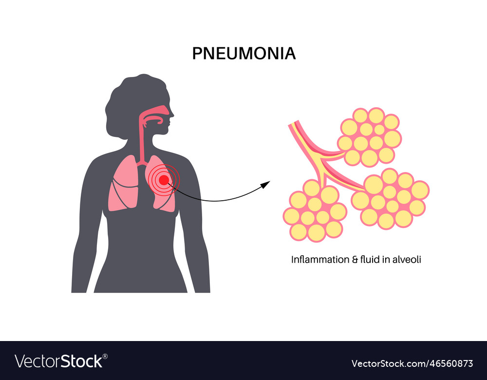 Pneumonia infection poster Royalty Free Vector Image