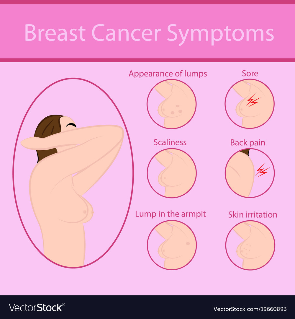 Breast cancer symptoms Royalty Free Vector Image