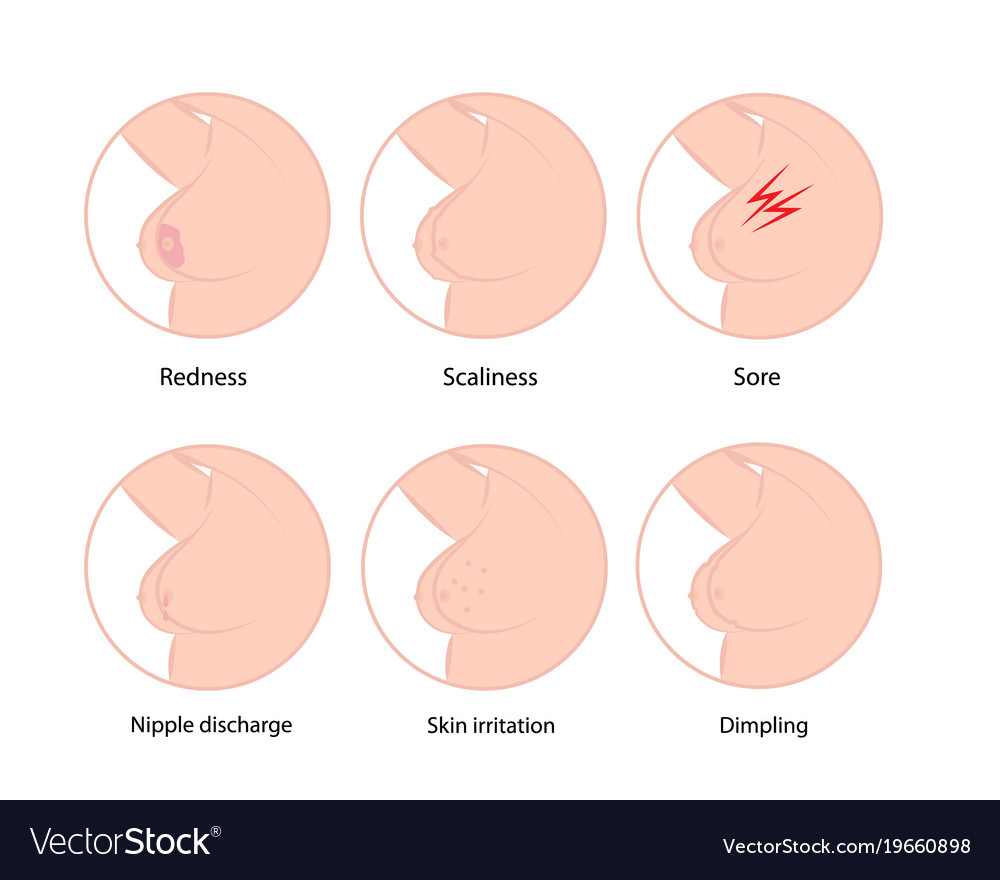 What Are Warning Signs of Breast Cancer?