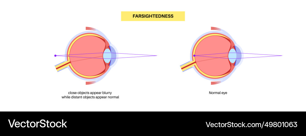 Normal eye and farsightedness Royalty Free Vector Image