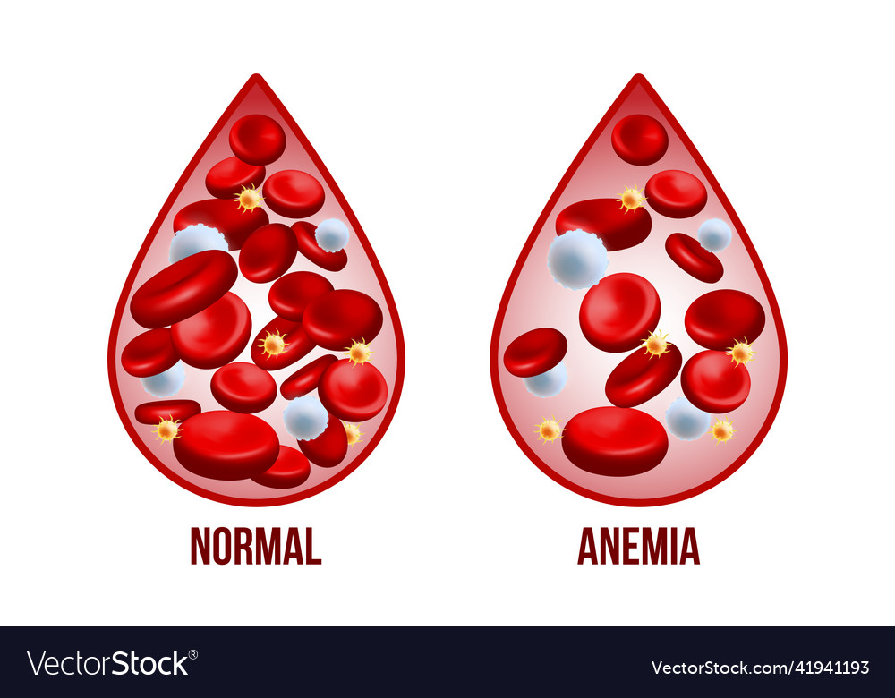 iron-deficiency-anemiathe-difference-of-anemia-vector-image