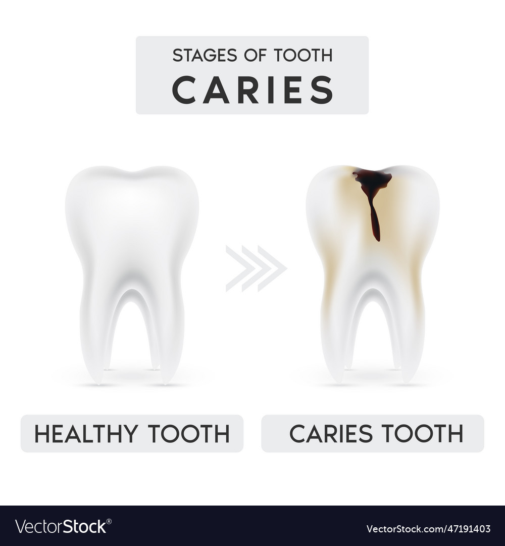 Tooth caries structure2 Royalty Free Vector Image