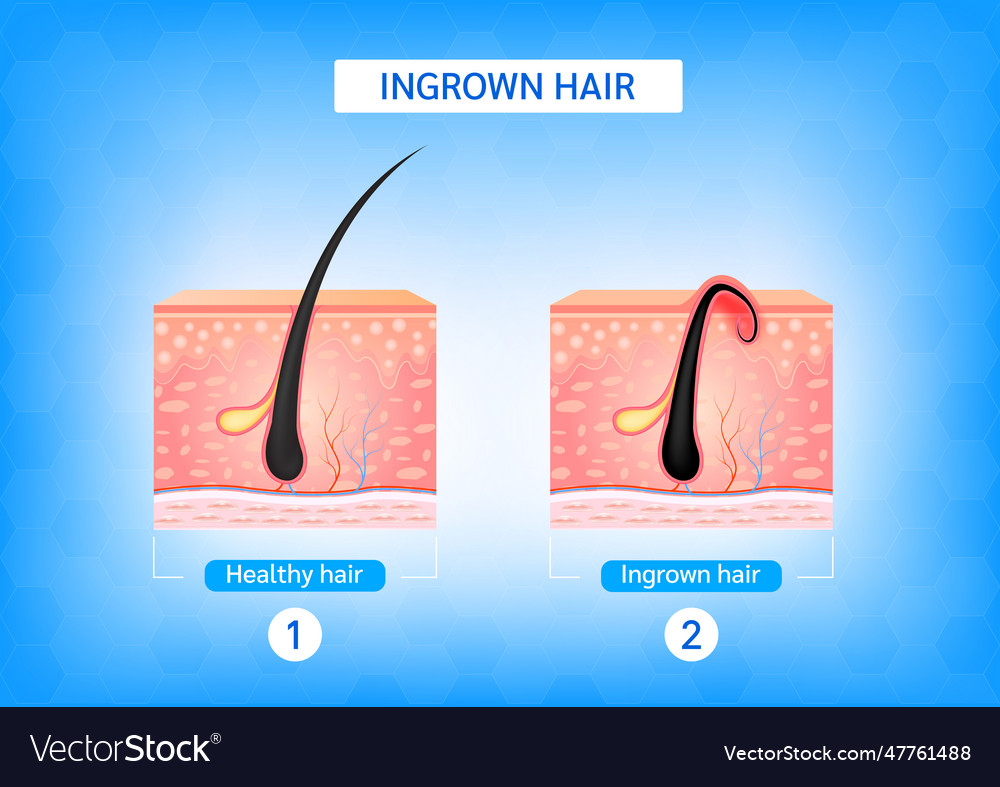 Formation of skin acne or pimple Royalty Free Vector Image