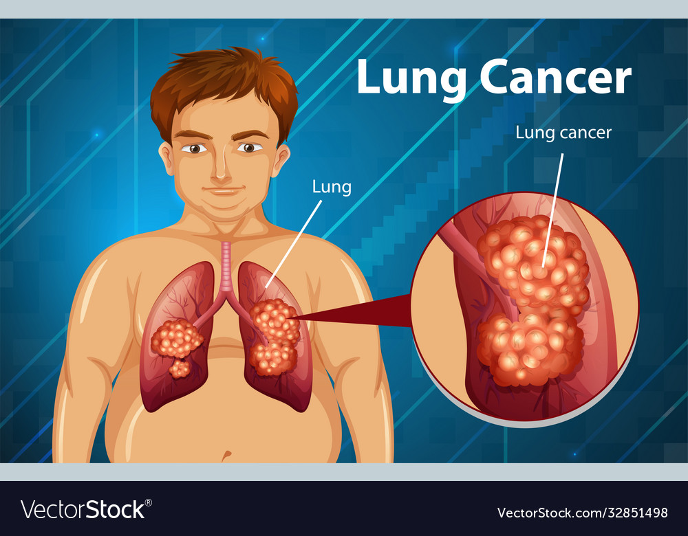 Informative lung cancer Royalty Free Vector Image