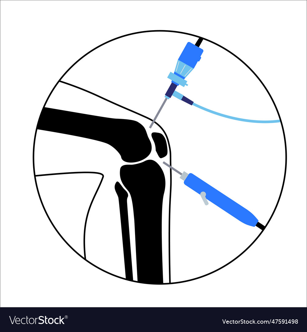 Knee joint arthroscopy Royalty Free Vector Image