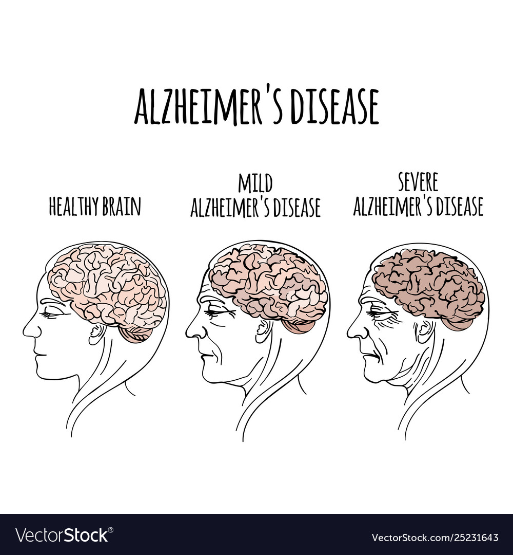 Dementia Alzheimer Disease Medicine Royalty Free Vector