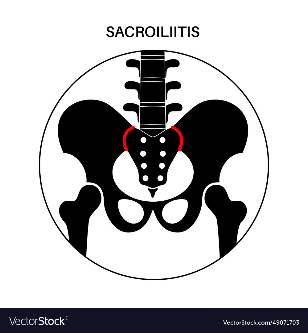 Sacroiliitis medical poster Royalty Free Vector Image