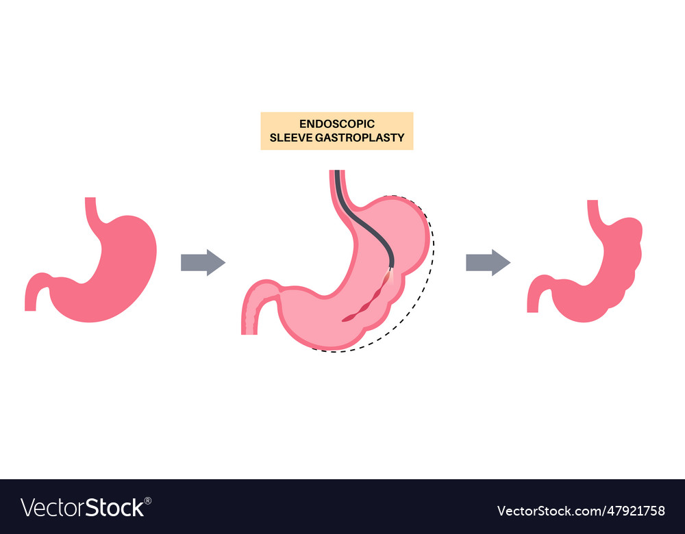 Endoscopic Sleeve Gastroplasty Royalty Free Vector Image