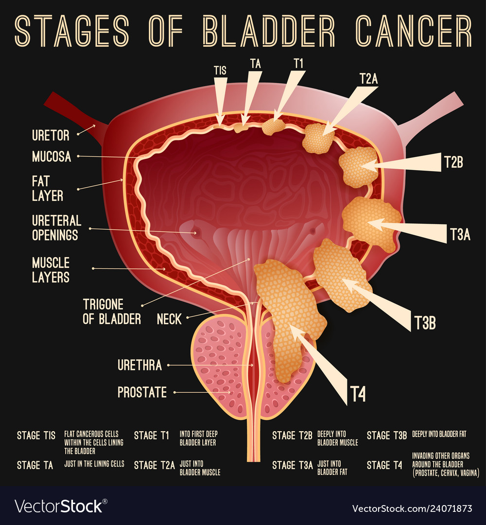 Bladder Cancer Stages Royalty Free Vector Image 2293