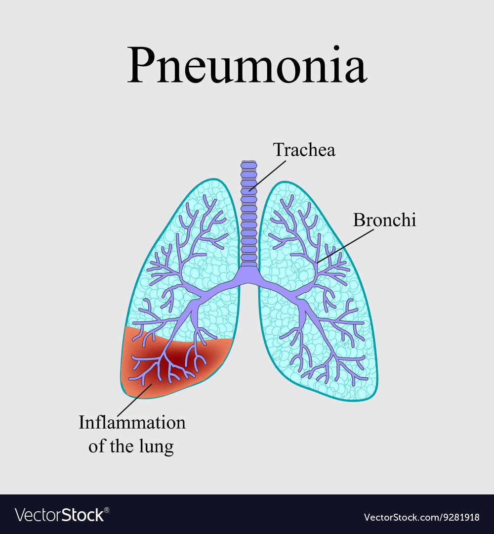 Pneumonia the anatomical structure of human Vector Image