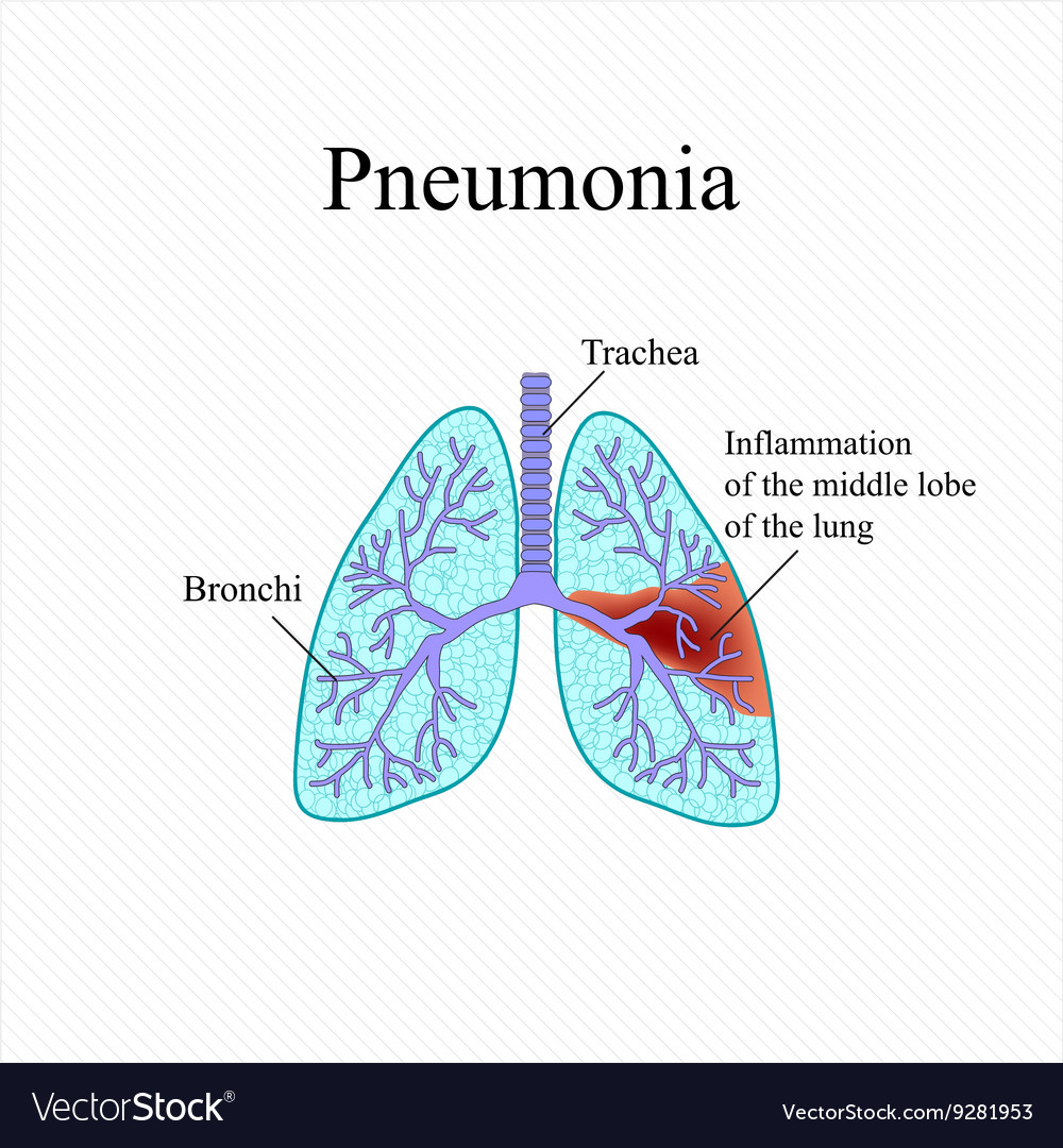 Pneumonia the anatomical structure of human Vector Image