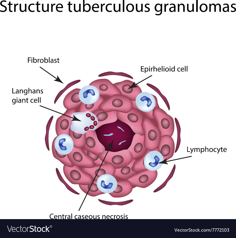 TB Granuloma Histology