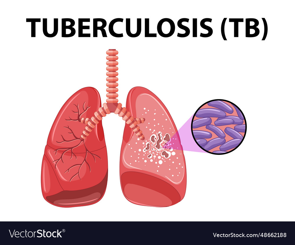 Human anatomy of lung with tuberculosis Royalty Free Vector