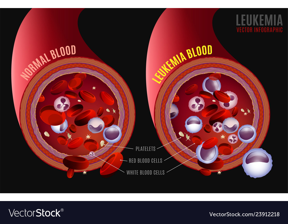 Leukemia Medical Infographic Royalty Free Vector Image