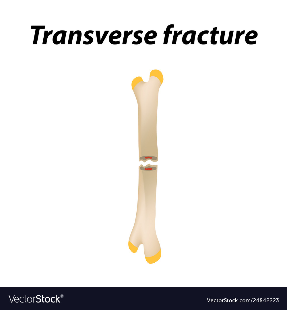 hairline-hip-fracture-fracture-treatment