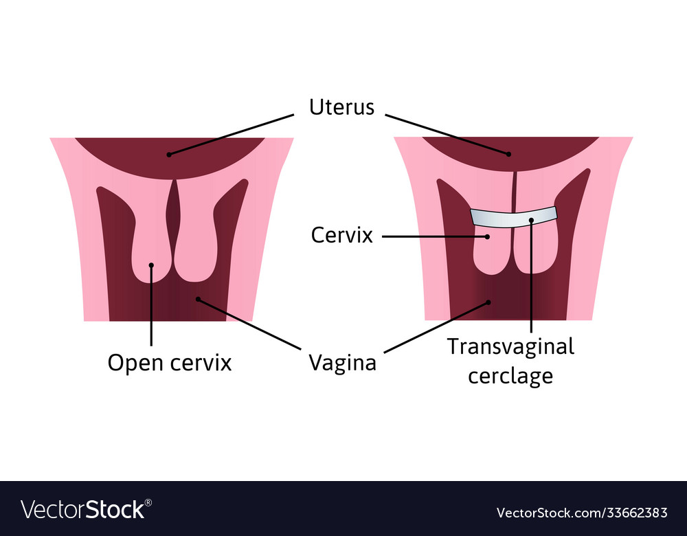 Cervical cerclage tightening opening Royalty Free Vector