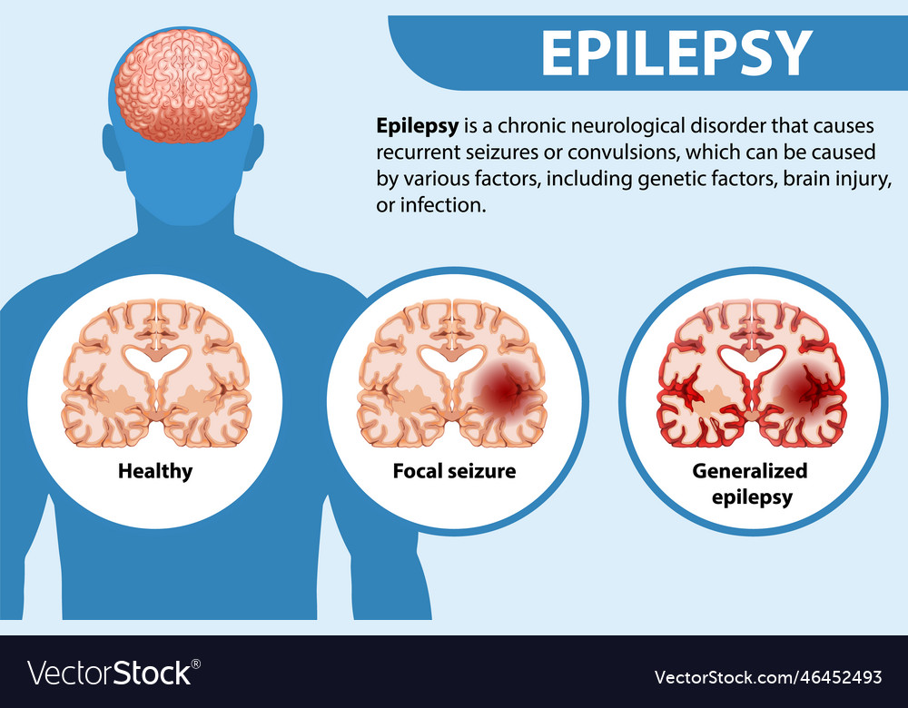 Informative poster of epilepsy Royalty Free Vector Image