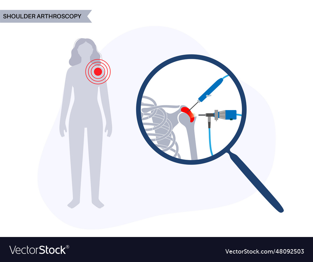 Shoulder arthroscopy poster Royalty Free Vector Image