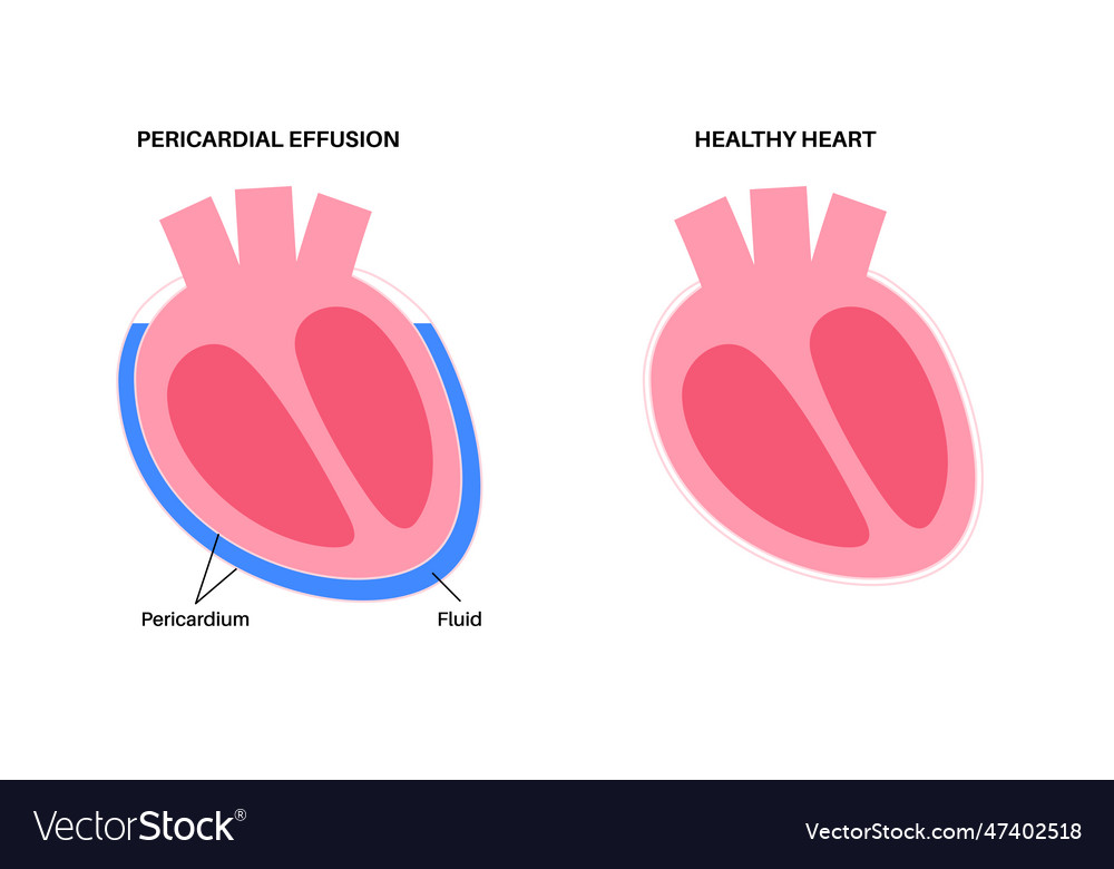 Pericardial effusion heart Royalty Free Vector Image