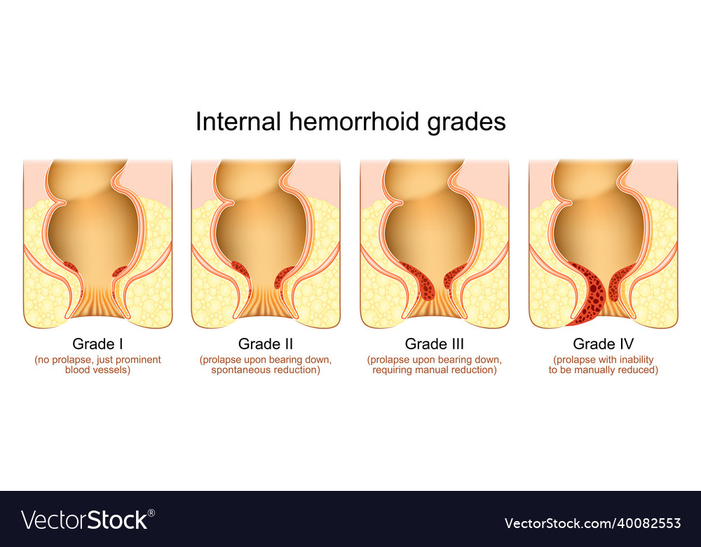 Hemorrhoid Grades Stage Of Internal Piles Vector Image 6463