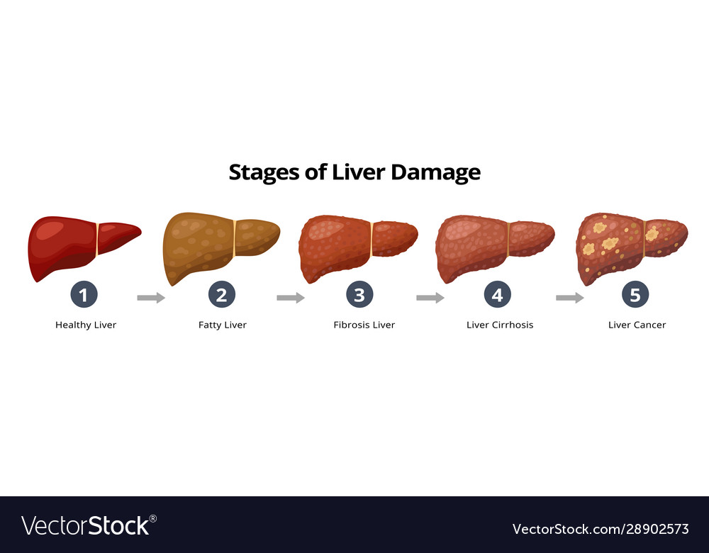 Stages liver damage from healthy fatty liver Vector Image