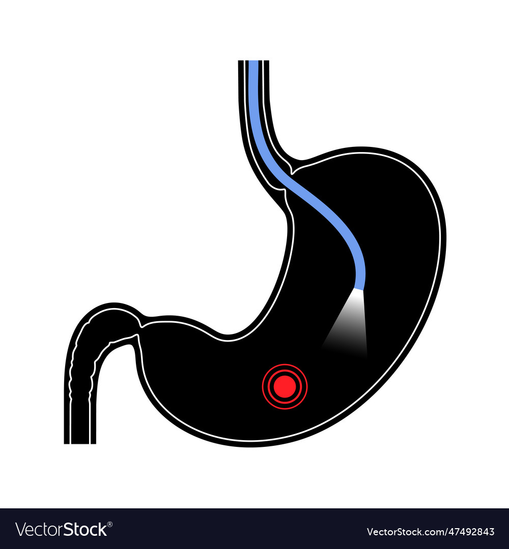 Gastroscopy Endoscopy Procedure Royalty Free Vector Image