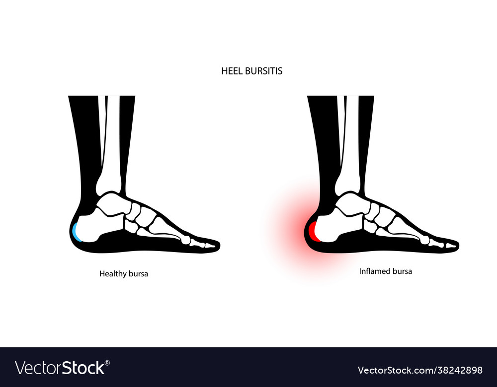 Bursitis inflammation concept Royalty Free Vector Image