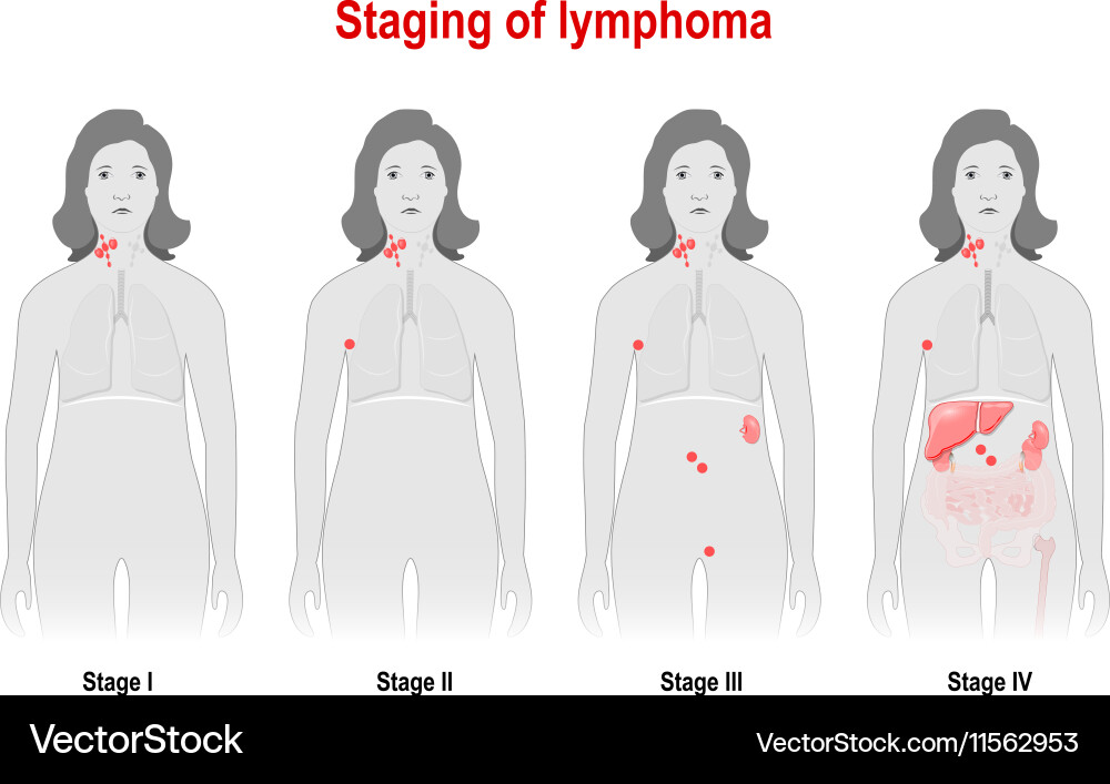 Staging of lymphoma Royalty Free Vector Image VectorStock