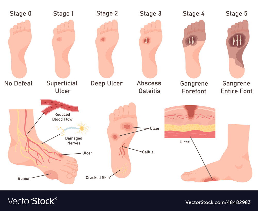 Diabetic foot diseases symptoms stage medical Vector Image