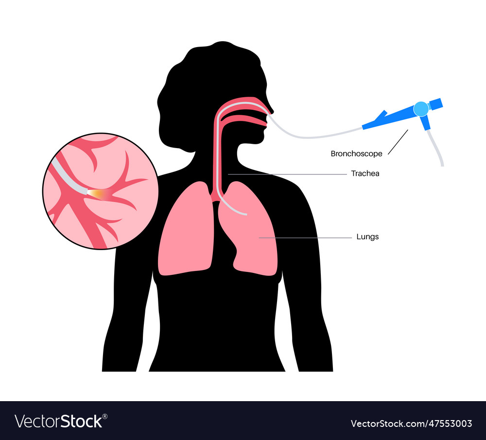 Bronchoscopy procedure concept Royalty Free Vector Image