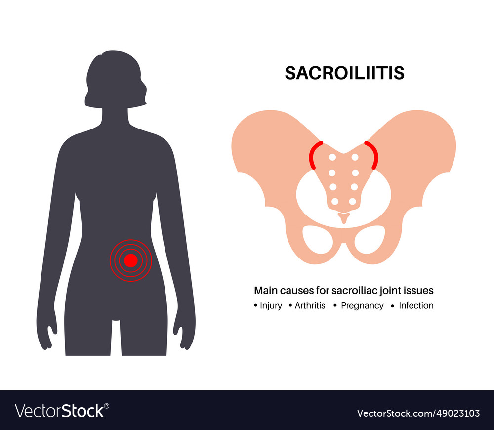 Sacroiliitis medical poster Royalty Free Vector Image