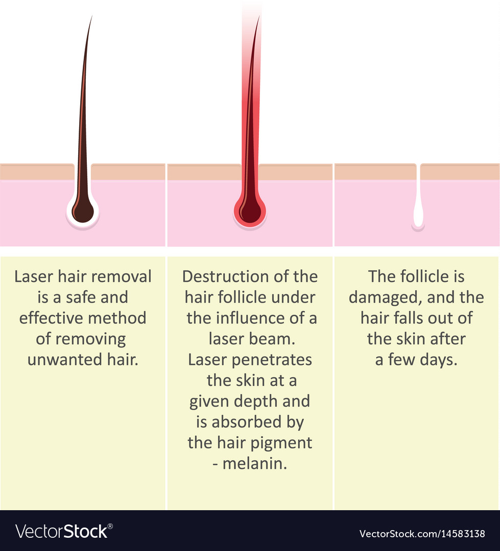 laser-hair-removal-description-procedure-vector-image