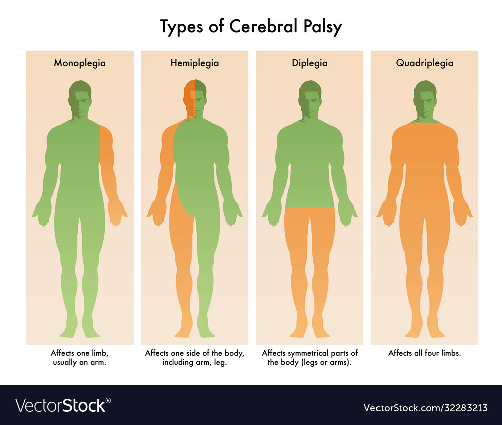 types-cerebral-palsy-royalty-free-vector-image