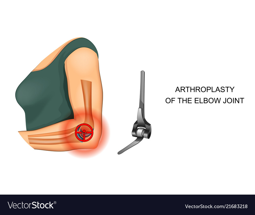 Endoprosthesis of the elbow joint